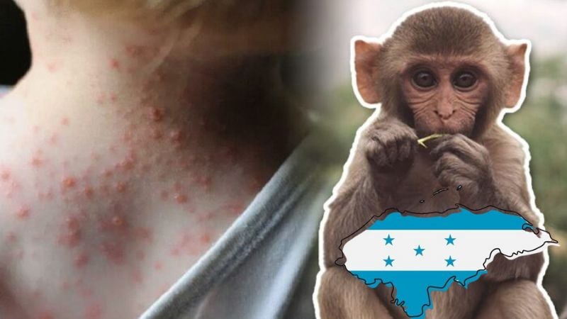 La Viruela Del Mono “Espanta” A Los Hondureños.
